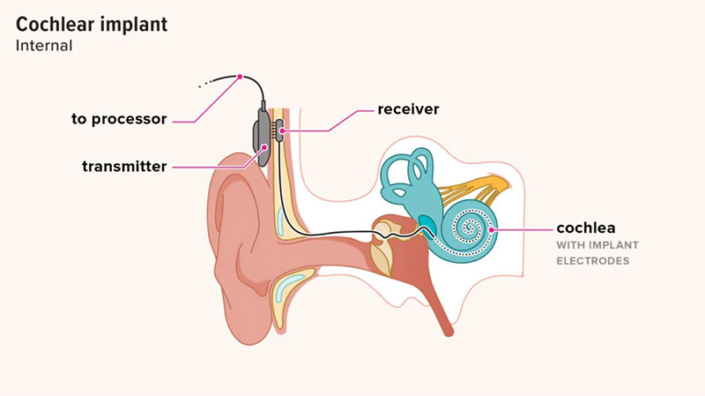 What Are Cochlear Implants And How Do They Work?